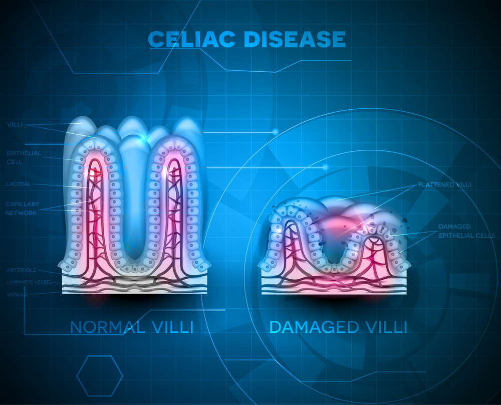 The Role of Genetics in Celiac Disease and Gluten Sensitivity