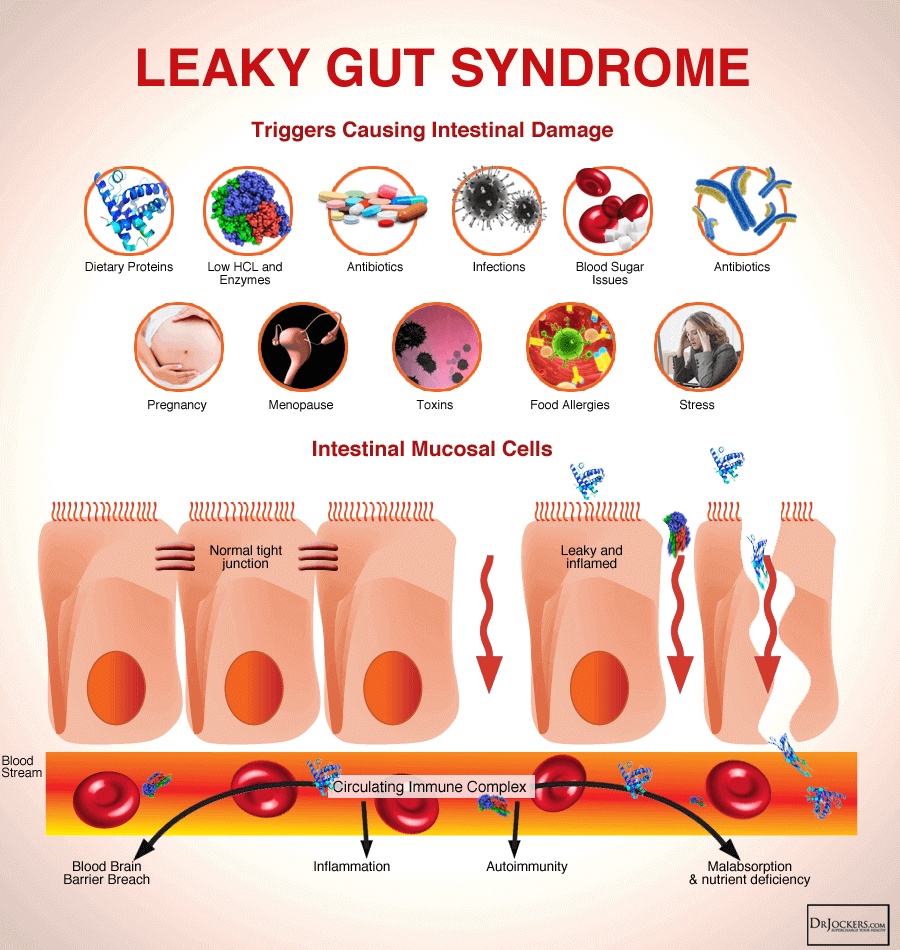 Unveiling Leaky Gut Syndrome: Causes, Symptoms, and Treatments