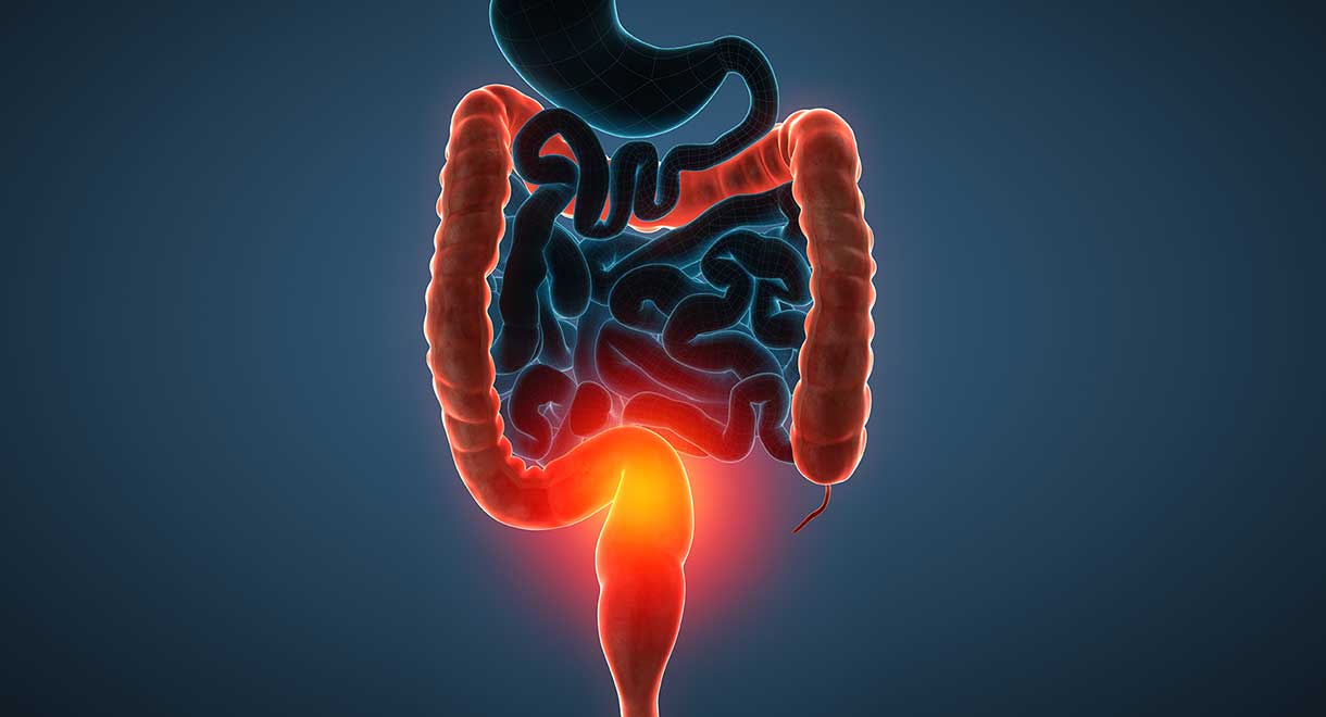 Understanding Ulcerative Colitis: Managing Chronic Inflammatory Bowel Disease with Diet